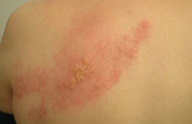 Herpes Zoster, tra il 20 e il 30% della cittadinanza a rischio Fuoco di Sant’Antonio: l’importanza dei immunizzazioni